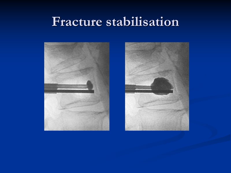 Fracture stabilisation